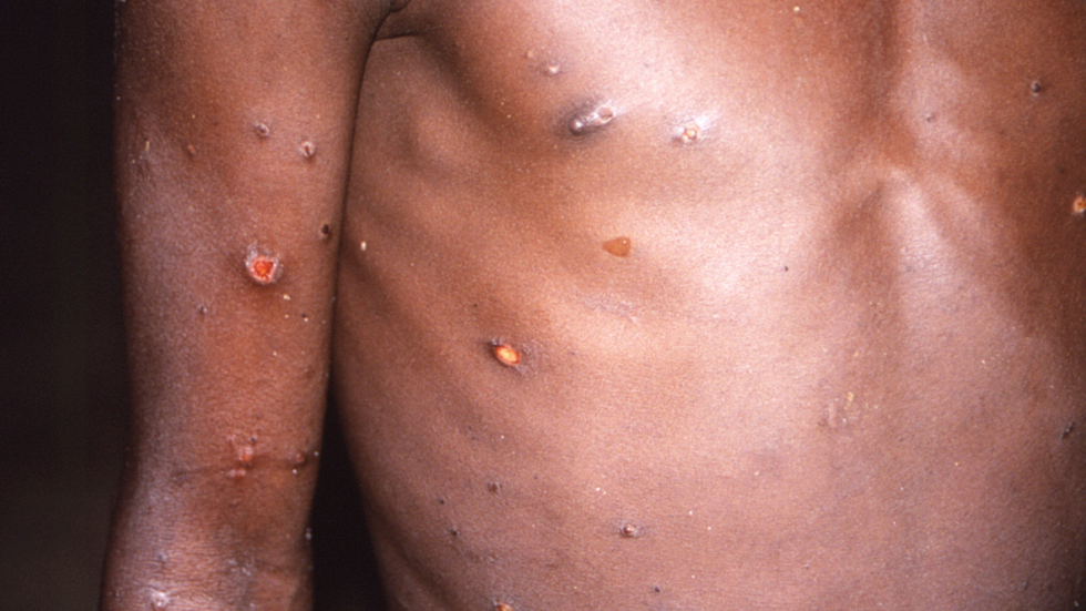 En bild på apkoppor från 1997 som distribuerats av CDC, USA:s motsvarighet till Folkhälsomyndigheten. FOTO: CDC via AP/TT