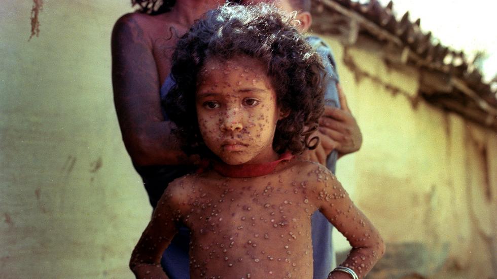 Flicka med smittkoppor 1974. I juni det året nådde den dödliga sjukdomen den indiska byn Hakegora. Foto: Santosh Basak/AP.