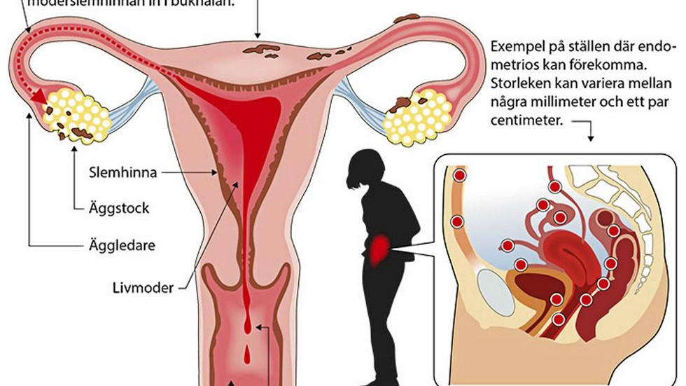Svåra smärtor vid menstruation, ägglossning och samlag samt nedsatt fertilitet följer i dess spår, skriver styrelsen för Endometriosföreningen.