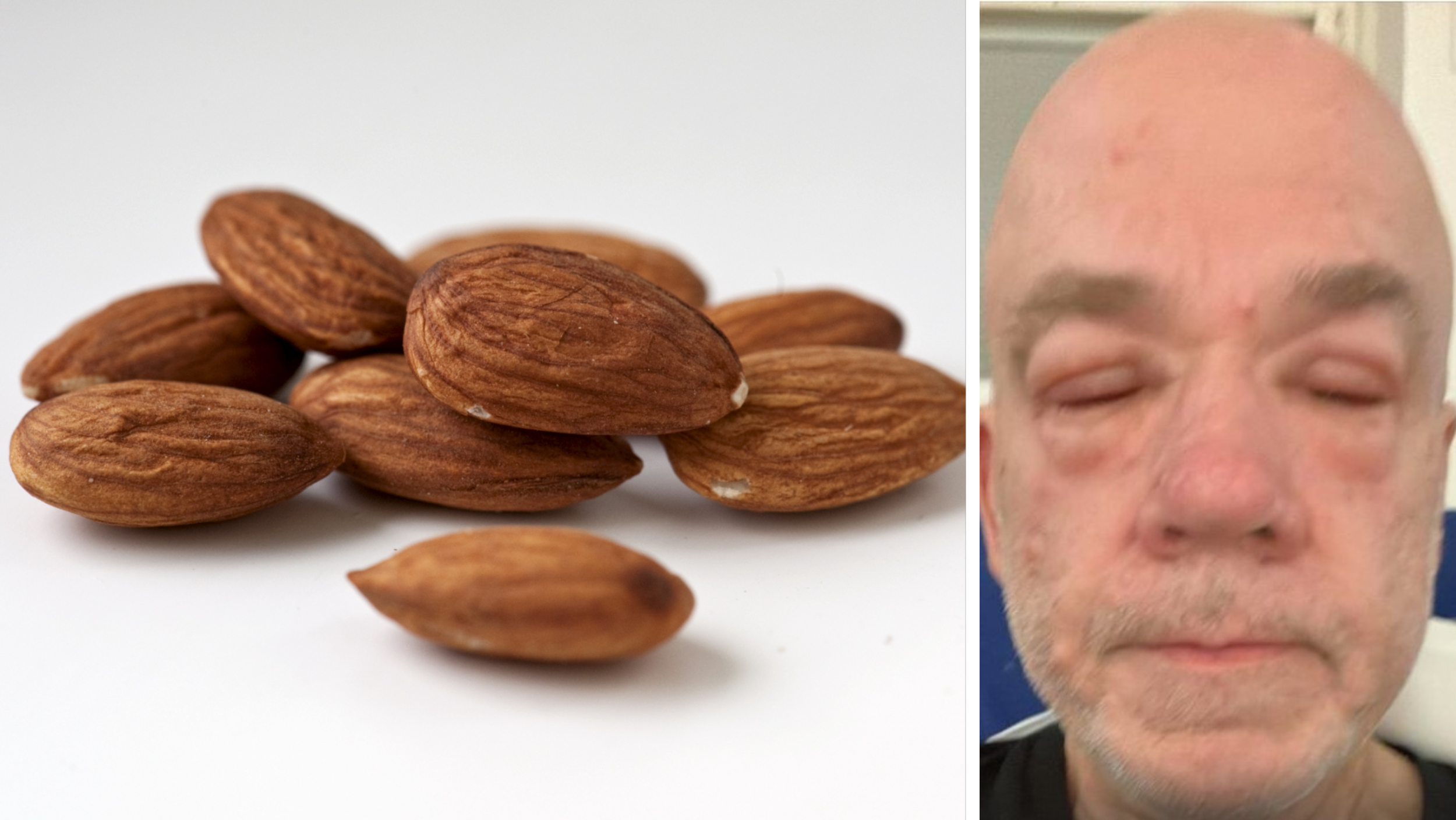 At the age of 64, Ronnie Rasmusson had his first allergic reaction when he ate a handful of almonds. 