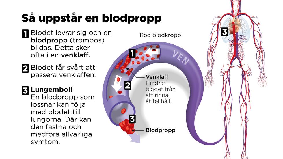 Blodproppar uppstår när blodet levrar sig och gör det svårare för blodet att passera i ett blodkärl.