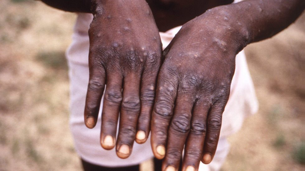 Apkoppor ger ofta upphov till utslag, sår och blåsor. Symtomen är ofta milda men kan bli allvarliga hos personer i riskgrupper. Arkivbild. FOTO: CDC/AP/TT
