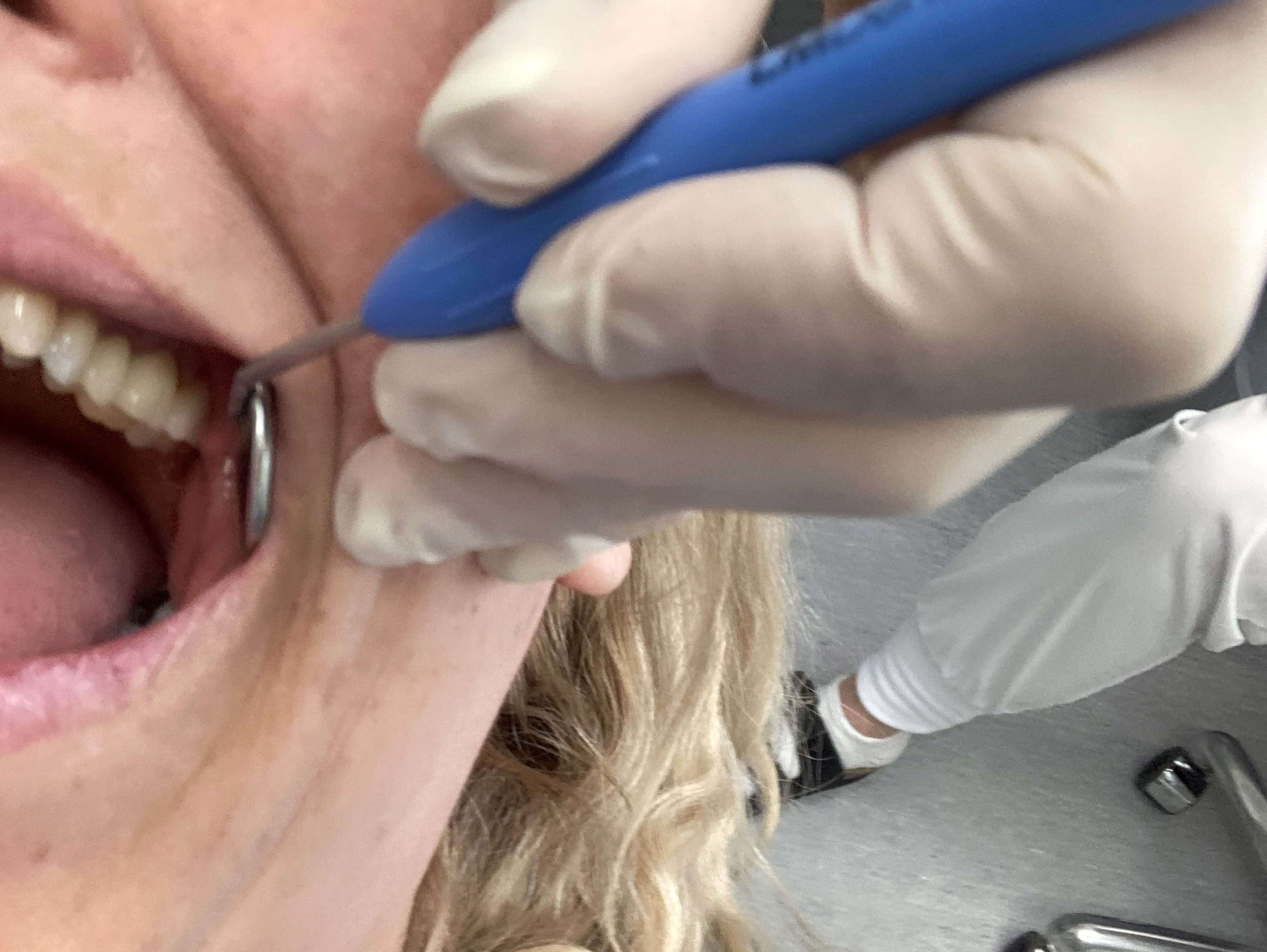 Enligt Inspektionen för vård och omsorg har tandläkaren från Jönköpings kommun varit grovt oskicklig vid utövningen av sitt yrke