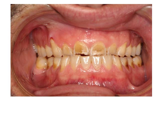Slitna tänder före behandling.
