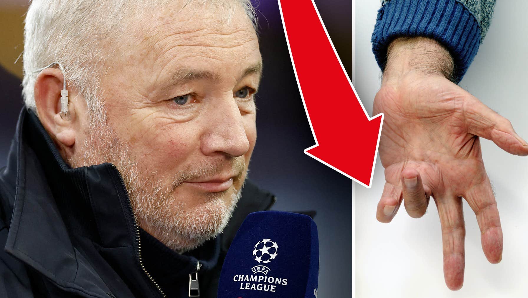 Fotbollslegendaren Ally McCoist drabbad av vikingasjukan